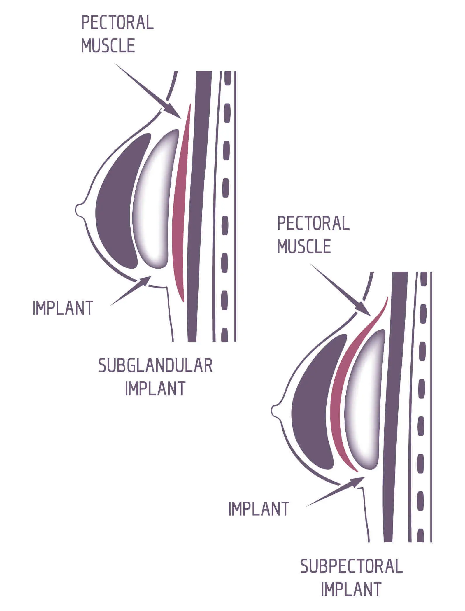 Diagram of implant placement