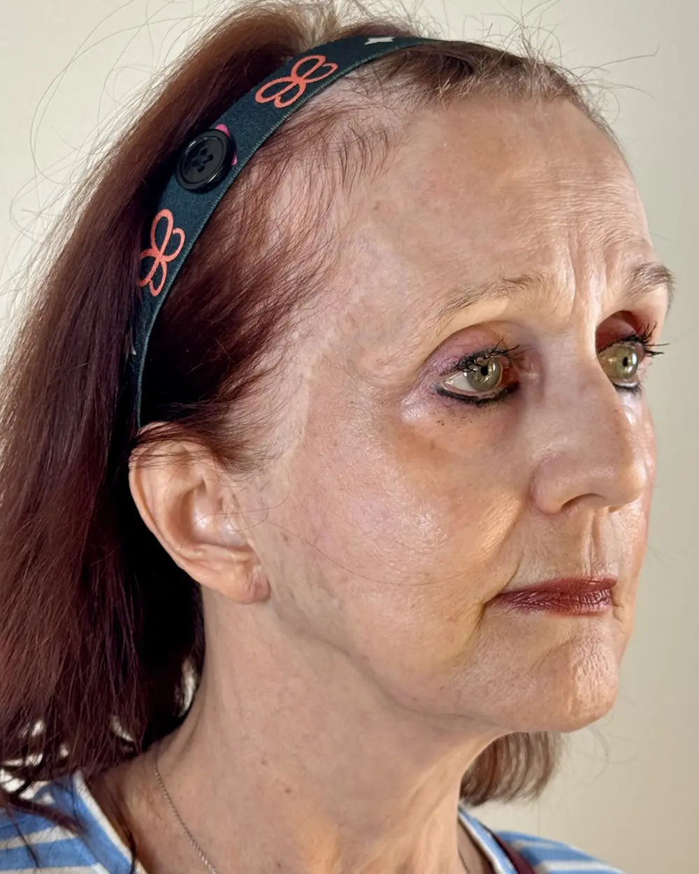 Case--9787 | Before Endoscopic Brow Lift 2
