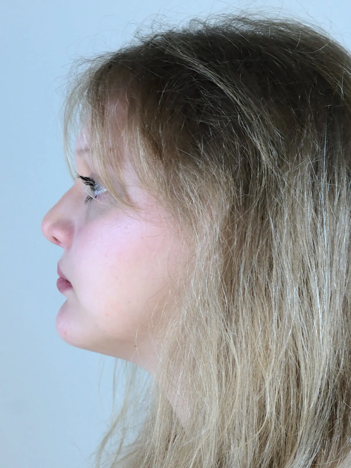 Case--1262 | After Rhinoplasty
