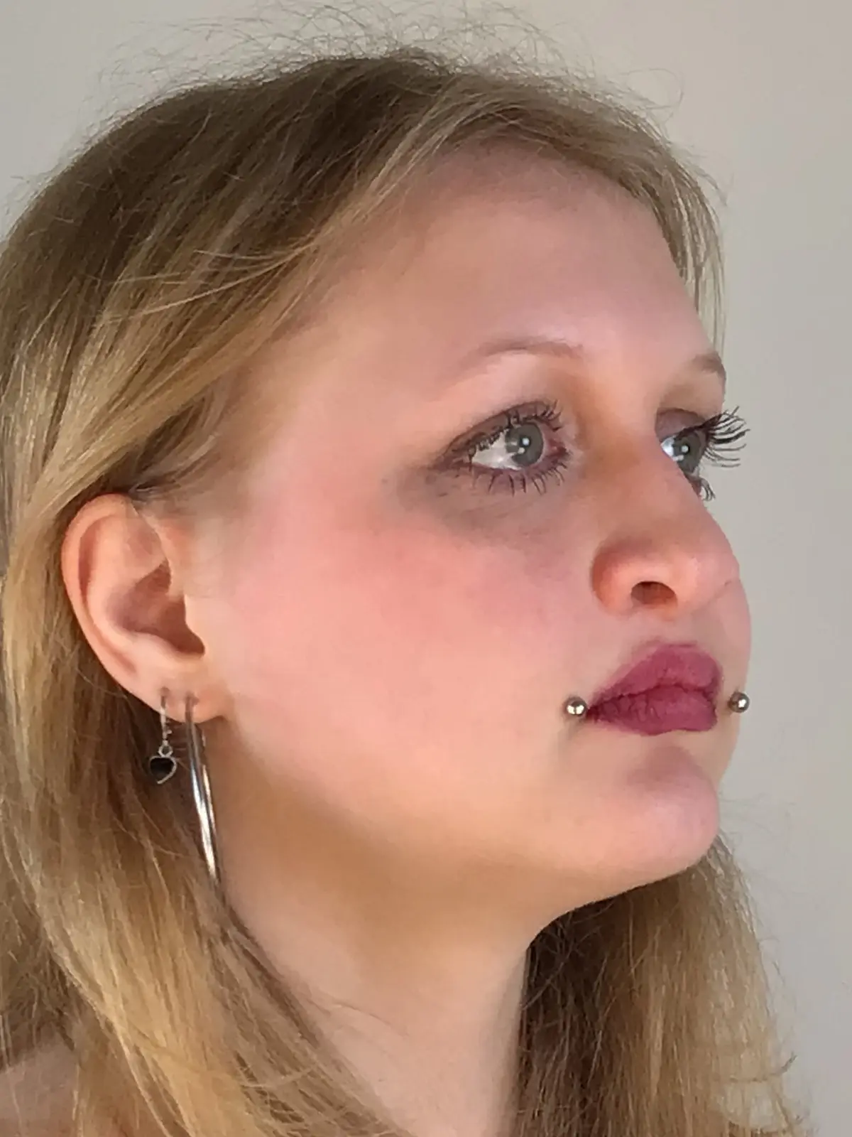 Case--1262 | Before Rhinoplasty 2
